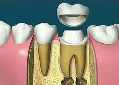 根管治疗卡通修复过程