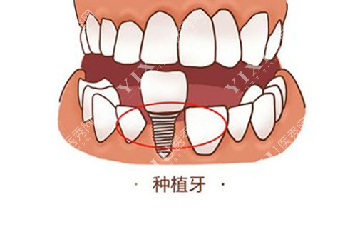 种植牙卡通示意图