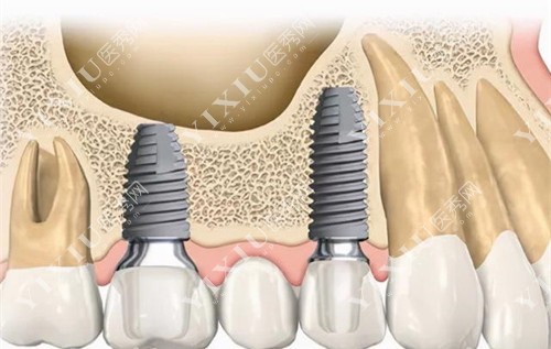 上颌牙种植内部卡通图