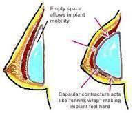 假体隆胸发生包膜挛缩怎么办